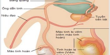 tim-hieu-ve-benh-viem-tinh-hoan-gay-nhieu-rac-roi-cho-nam-gioi